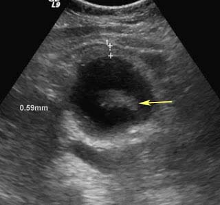 Figure 2 : Intraoperative Findings
