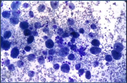 Figure 1 : Abundant watery thin colloid in Colloid Goitre