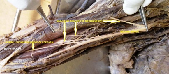 Fig. 2 : Right upper limb showing absence of Musculocutaneous nerve and separate muscular branches arising from Median nerveIn right upper limb of the same cadaver, musculocutaneous nerve was found absent. The median nerves arising normally, but during its distal course in the arm it was observed that the nerve was giving separate individual branches to all the musclesof anterior compartment of arm and passing under the brachial artery from lateral to medial side.
