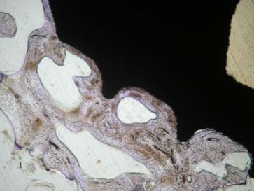 Figure 6 : Cervical implant made of bioactive titanium (2004)