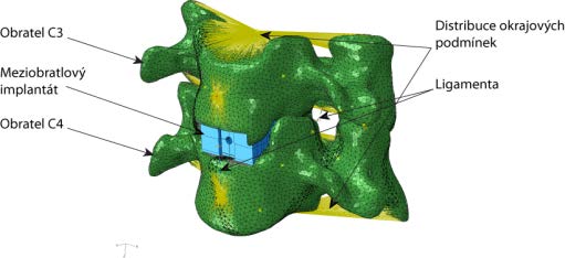 Figure 8 : Implant for use in ACIF (PEEK/TCP) 2010