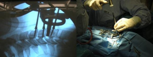 Figure 11 : Unstable injury C6/7 (Aebi-Nazarian -A3) (2009) Trauma MRI-T2, X-ray 6 months after the surgery -bioactive titanium