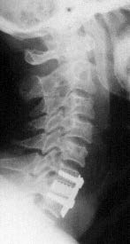 Figure 14 : CT after 12 months with signs of migration of osteoblasts along the anterior and lateral walls of the implant, section C5/6