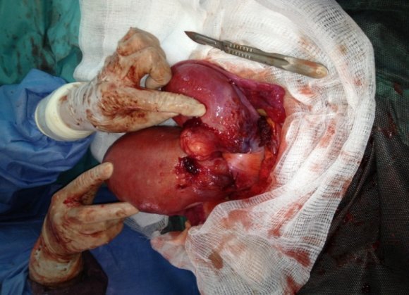 Fig. 1 : Étiologiesdes thrombopénies au cours de la grossesse en fonction du terme PTI : purpura thrombopénique immunologique ; PTT : purpura thrombopénique thrombopathique ; HELLP syndrome ; SHU : syndrome hémolytique et urémique ; SA : semaines d'aménorrhée En 1996, la découverte du rôle joué par une métallo-protéase (ADAMTS-13) dans le clivage du facteur Willebrand[2] ;[3], puis la mise en évidence de son déficit dans le PTT (mais pas dans les autres formes de MAT [4] [5]), a permis de préciser la physiopathologie de cette affection et de faire évoluer la classification des MAT. Un déficit sévère en métalloprotéase apparaît donc comme spécifique du PTT.La mise en évidence d'auto-anticorps dirigés contre l'ADAMTS-13, dans les formes acquises a été la justification de l'utilisation récente du RITUXIMAB dans cette indication avec des résultats très prometteurs. L'incidence annuelle est de deux à sept cas par million d'habitants[6] et semble en augmentation. Elle touche essentiellement les femmes (sexe ratio : 3F/1H). L'âge d'apparition de la première poussée se situe souvent dans la quatrième décennie bien que des formes plus tardives ou, au contraire, chez l'enfant, soient observées. La mortalité est d'environ 15 %[7], probablement sous-estimée en raison d'une mortalité précoce dans les 48 premières heures. La grande majorité des PTT est considérée comme idiopathique et de survenue sporadique. Des facteurs étiologiques sont retrouvés dans environ 10 % des cas[7] et correspondent aux PTT associés à la grossesse, à des infections, aux cancers et à certains médicaments.