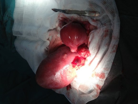 Fig. 3 : Démarche diagnostique devant une thrombopénie au cours de la grossesse. (D'après Federici L. et al. Presse Med 2008;37:1299-307) HTA : hypertension artérielle ; TP : taux de prothrombine ; Fb : fibrinogène ; Dd : D-dimères ; CIVD : coagulation intravasculaire disséminée ; TGI : thrombopénie gestationnelle idiopathique ; HELLP : hemolysis, elevatedliver enzymes, and lowplatelet count ; PTT : purpura thrombopathiquethrombocytopénique ; SHU : syndrome hémolytique et urémique ; LED : lupus érythémateux disséminé ; SAPL : syndrome des antiphospholipides ; * : examen nécessaire en l'absence de syndrome hémorragique.