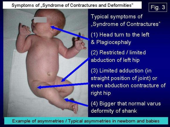Figure 3 : (Post op AP with plate)