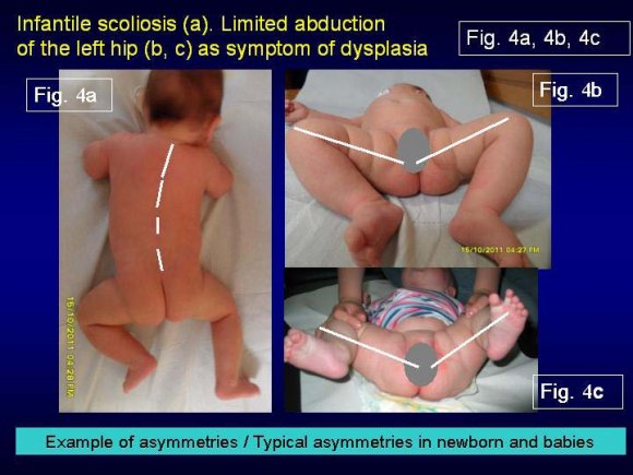 Figure 10 : Additional causes of scoliosis connected with CNS -tests (Central Nerve System)