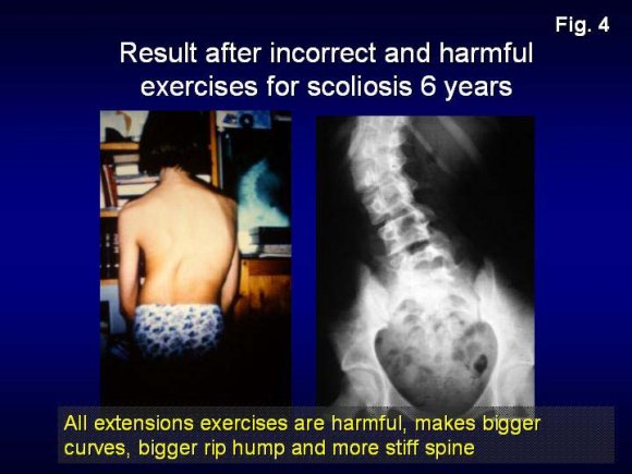 Figure 6 : New exercises for scoliosis