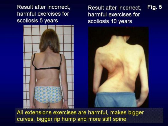Figure 7 : New exercises for scoliosis