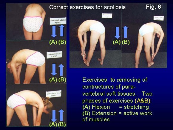 Figure 9 : New exercises for scoliosis