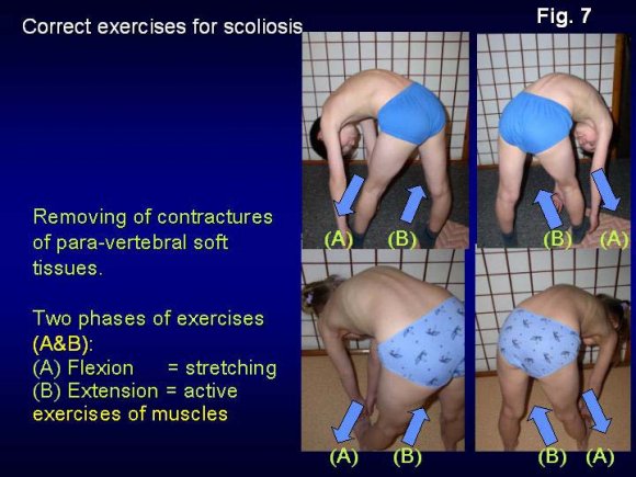 Figure 11 : Results after new exercises for scoliosis