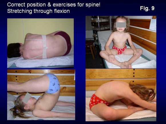Figure 14 : Results after new exercises for scoliosis