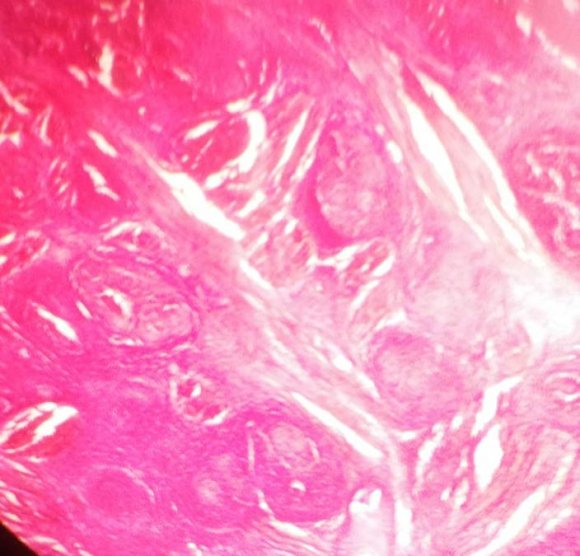 a) Histopathological Sections The Histopathological Sections are depicted in following different views of the present case. scanner view (Tubercular Granuloma) 10x(Tubercular Granuloma) 40x(Tubercular Granuloma)