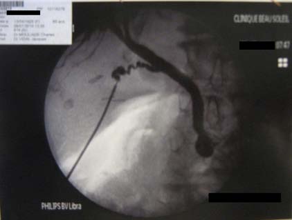 Figure 4 : CT scan with IV c ontrast , coronal view (Porto venous phase) showing the extravasation of the contrast (the arrow) indicating active bleeding