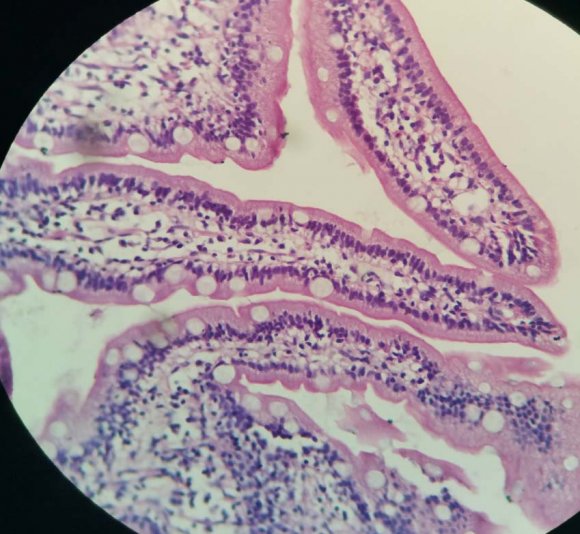 Figure 2 : Type B1 CD: Partial atrophy of villi with increase in intraepithelial lymphocytes (H&E x 100) The type 2 hyperplastic lesions category according to modified marsh classification has been omitted in the new Corazza classification due to the doubts in its usefulness and efficacy. The new patients would already be diagnosed by increased IELs and hence this category does not impart any useful information about the disease although it definitely represents a spectrum of the histological stage.(2,3,5) In our study, a very minor number of cases were classified into this category. (Table 2) Type 3c category of Marsh classification has been re designated as B2 and these are the very commonly encountered lesions in CD. This category lends itself to very less subjective variation as the histological changes are very marked and striking leading to a greater diagnostic reproducibility.(2,3,4,5,7,8,9,10) In our study too, very good intraobserver and interobserver agreement as found in this category. (Table 2,3,4,5,6) (FIG 3)