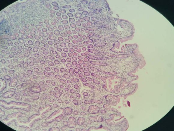 Figure 3 : Type B2 CD: Complete atrophy of villi (H&E x 100)