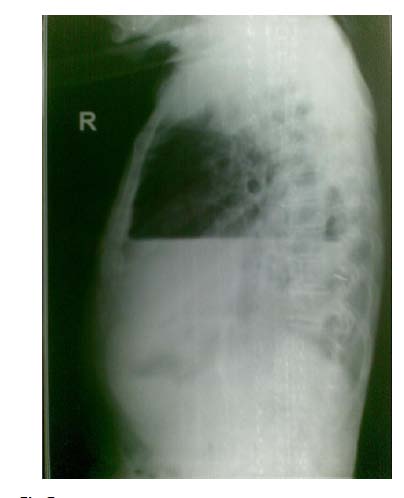 is a horizontal fluid which is because of simultaneous presence of fluid and air in the thoracic Pneumothorax: An Emergency! How Do I Diagnose in a Primary Setup? Volume XV Issue 1 Version I Year 2015 ( D )