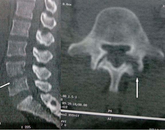 Journals Inc. (US) from L4-L5 and L5-S1 without spondylodiscitis associated (figure2). The diagnosis of pulmonary tuberculosis and zygapophysial tuberculous arthritis was accepted. The healing was achieved after 12 months of antituberculous treatment (2 months of RHZE and 10 months of RH) associated with immobilization by a back brace.