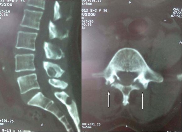 Figure 2 : Lumbar CT scan showed bilateral zygapophyseal arthritis from L4-L5 and L5-S1 without spondylodiscitis (patient 2)c) Observation 3A 47-year-old female patient, with type 2 diabetes and with hypertrophic cardiomyopathy was hospitalized for low back pain and poorly systematized sciatica that developed chronically and became hyperalgesic about 1 month before hospitalization, causing difficulty in walking. She presented no visceral sign and this symptomatology was developed in a context of intermittent fever with a weight loss of 10 kg in 6 months. Clinical examination revealed a lumbar spinal syndrome with painful points at lumbar spine, a limitation of spinal movements with impossibility of extending the lumbar spine and a Schöber index at 10+2, a radicular syndrome with positive Lasègue's sign at10 °. The TST was negative as well as the HIV serology. ESR and CRP were respectively 90 mm and 41.64 mg/l. Lumbar CT scan revealed an intraductal hypodensity at the L3-L4 stage requiring the performance of a lumbar MRI which brought out a multistage zygapophyseal arthritis from L2 to S1 associated with epiduritis (figure3). The evolution was favorable with immobilization with a back brace and after one year