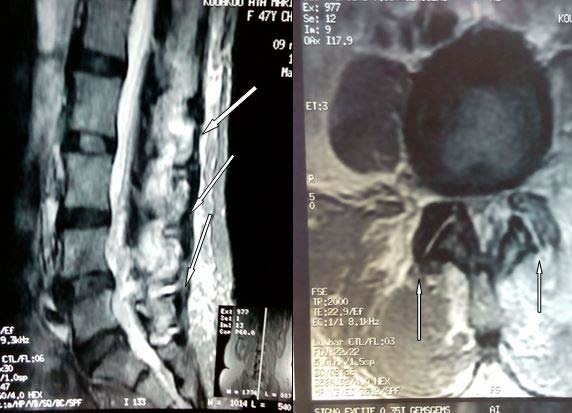 Figure 3 : MRI of the lumbar spine showing in T2 sequence with fat suppression, a hyperintensity signal, next to zygapophyseal joints from L2 to S1 associated with taking contrast of zygapophyseal joint L3-L4, most seen in the left joint