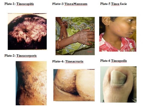 Epidemiologicalstudies on Dermatophytoses in Warangal District, Telangana State, India