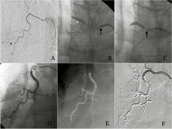 Figure 2 : Patient 2. A. Proximal Onyx injection through a double lumen balloon microcatheter during inflation (white asterisk) in a renal graft. Extreme distal reach of the liquid agent without reflux. B. The goal in the present case was to avoid reflux into external iliac artery (arrow) as well as distal embolization. Vascularization from cicumflex iliac artery is also seen (asterisk). C Withdrawal of the balloon microcatheter showing minimal reflux around the distal part of the balloon (arrow) and non-target embolization. Posteriously, we occluded the circumflex iliac artery as well (black asterisk) c) Case 4A 60-year-old male patient with an intense hemoptysis episode (1000 ml/24 h) was consulted to IR unit. Angio CT identifed an enlarged single right bronchial artery (4 mm) in addition to aneurysm like formations in the lower right lobe, findings in relation to necrotizing pneumonia.In one hand, the Ascent ballon microcatheter was employed to help us to achieve a more stable position of the diagnostic catheter. For that reason, the dual lumen ballon catheter with the microwire were tracked into the bronchial artery, a gently inflation of the ballon allowed us to advance the diagnostic catheter over the system, achieving a more stable position (Fig.3).