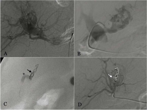Figure 3 : A-F. Patient 4. A. DSA, selective injection from an enlarged right bronchial artery showing aneurysms-like formations in lower lobe (asterisk). B-C. Anchoring technique: Despite the passage of the glidewire to the artery not enough stability was achieved in the diagnostic catheter (arrow). Gentle inflation of the Ascent ballon (asterisk) in the bronchial artery allowed advancement of the 5Fr catheter over the system. D. Inflation of the ballon created a mechanical plug (asterisk) and Onyx injections was done sucessfully. E. After balloon deflation neither reflux nor adherence of Onyx to the catheter was noted. F. Final angiography showing complete occlusion of the artery and Onyx cast.