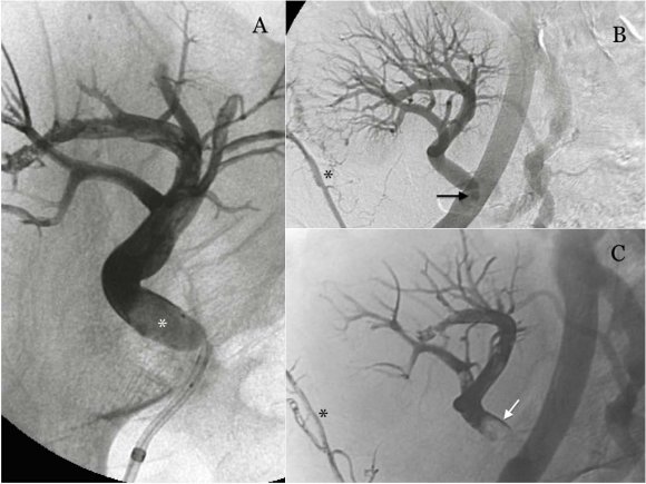 Figure 3 : Total Response to treatment.4a. GIST tumor in greater curvature aspect of hypodense, extraluminal, lobed, before the surgery. 4b. Postsurgical control where no lesions in the gastric wall are observed.