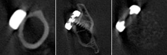 Figure 3 : Trabeculae, scaffold and osteosynthesis can be clearly recognised with the fpvCT without significant artefact formation (axial slices, left picture through the diaphysis of the femur proximal the osteotomic cleft, central picture through the femoral neck, right picture through the middle of the osteotomic cleft)
