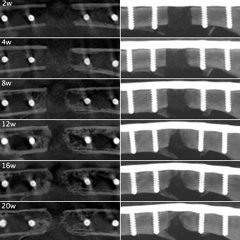 Figure 4 : The scaffold is clearly recognisable in the osteotomic cleft (left picture coronar slice in the middle ofe the osteotomic cleft, right picture sagital slice in the middle of the osteotomic cleft)