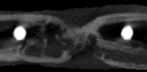 Figure 5 : Growth behaviour of the bone over the course of time (indicated in weeks from top to bottom, right column the reconstructed radiographs, left column coronar slices in the middle of the osteotomic cleft, sinistral distal, dexter proximal)