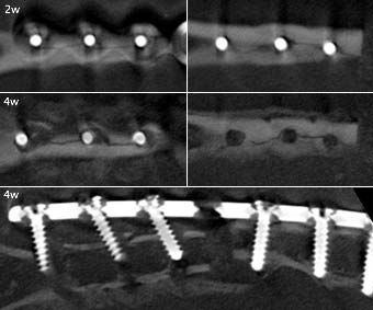 Figure 6 : Identifiable non-union of the bone that appeared bridged on projection roentgen