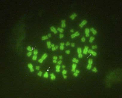 Figure 2 : Q-heterochromatin regions (Q-HRs) of the human chromosomes after Q-staining. Q-HRs of large sizes and 5th degree intensity of fluorescence on the short arms of both chromosomes 13 and Q-HR of medium size and 5th degree of fluorescence intensity in the pericentric region of chromosome 3.