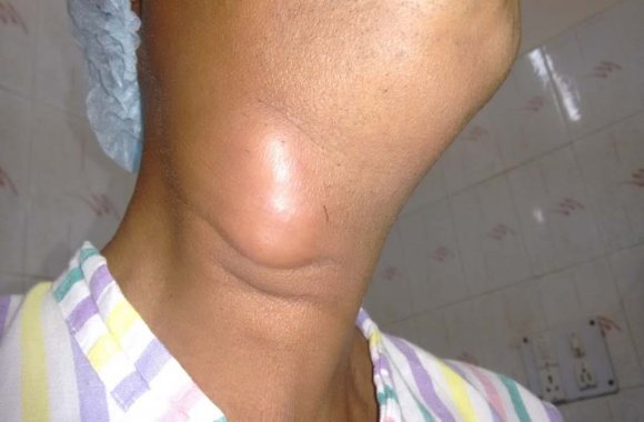 Figure 2 : Right side mandibular nerve palsy