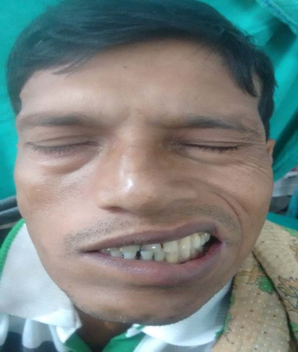 Figure 3 : CT scan neck showing submandibular abscess