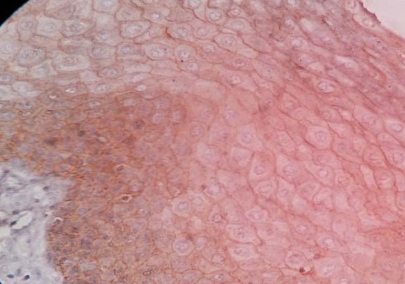 Figure 2 : Expression of ?-catenin in normal oral epethelium .40X