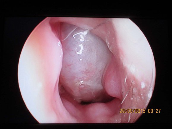 Figure 3 : 3D CT patient's status, 6 months after surgery.