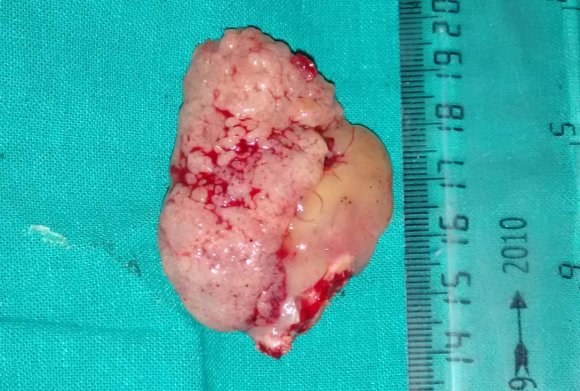 Figure 7: Axial projection X-ray of the patient 7 days after the surgery.