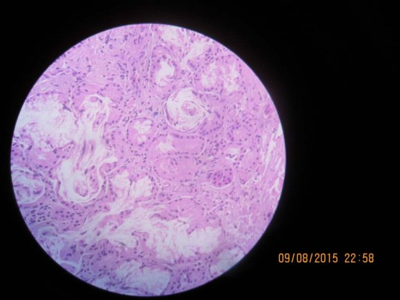 Figure 8 : MSCT facial bones of the skull of the patient S., 28 years, 6 months after osteosynthesis in the defected ZAC area.