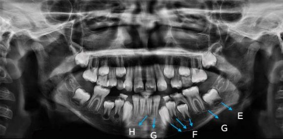 Figure 2 : Different cervical vertebra maturation stages (CVMS) from the current clinical cases.