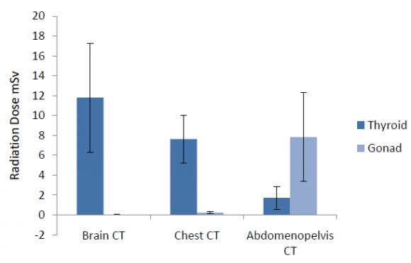 value-0 to 10 dB decay within 60 seconds II. Cochlearlosses-15 to 20 dB decay within 60 seconds. III. Neurallosses -30 dB or greater within 60 seconds. Left Ear Treshold is 70 dB & Intensity for Tone Decay is 90 dB , therefore decay show range 30 dB.So indicates Neural Loss. 3. Owen's Tone Decay Method: It starts at Threshold; the difference is that 20 seconds rest period is advised previous to subsequently 5dB increment. Result: I. Normal Values -5dB decay II. Cochlear losses-10 to 20 dB decay III. Neural loss-25 dB or greater decay Tone decay Test for object No 3: OWEN'S METHOD Each reading has taken with 20 sec rest period, Intensity level at which the tone sensation & tonal quality is maintained during full 60 sec is above 25 dB. It indicates Neural Loss.