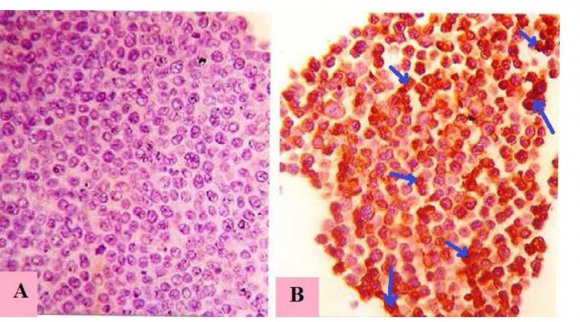 Figure 10: The picture of stained EAC cells sections depict decreased number of cells, necrotic area (1) (fig: 10D; × 400), irregular shrinked cells (4) (fig: 10B; × 100 and fig 10F; × 1000), plasma membrane blebbing (5), azurophilic eosinophilic vesicle (8), fragmenting nuclei (6) and apopoptic bodies (7) (fig 10F) by reason of remedy of EAC bearing mice with ethanol extract of combination of Punica grantum L and Ziziphus mauritiana in comparison with EAC bearing control which indicated extremely proliferation and division of cells (3) with plentiful basophilic cytoplasm (2) (fig 10A; × 100, fig 10C; × 400 and fig 10E; × 1000).