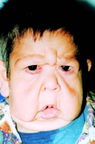 [3]: Cutis Laxa congénitale et acquise :La Cutis Laxa Autosomale Dominante (ADCL) : Les symptômes de l'ADCL peuvent surgir à tout moment entre la naissance et le début de l'âge adulte. Chez certains patients, il n'existe que le symptôme de peau lâche. Cependant, certaines familles présentent également des caractéristiques faciales spécifiques concernant le nez et les yeux ainsi que des problèmes cardiovasculaires et pulmonaires tels que anévrisme aortique et emphysème. Une échocardiographie et un bilan des fonctions respiratoires sont recommandés chez ces patients afin d'identifier les complications pulmonaires et cardiaques avant qu'elles ne présentent un risque vital. Bien que la plupart des cas d'ADCL résultent de mutations sur le gène de l'élastine (ELN), il a été trouvé au moins une famille avec l'ADCL présentant une mutation du gène Fibuline-5 (FBLN5) qui Year 2016 Cutis Laxa Syndrome: Clinical and Prognosis: A New Case Report est la cause de la Cutis Laxa Autosomale Récessive Type 1B (ARCL1B).