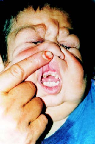 ARCL3 ou Syndrome De Barsy a un phénotype commun avec ARCL2A et ARCL2B. Il provoque une Volume XVI Issue IV Version I © 2016 Global Journals Inc. (US) Cutis Laxa Syndrome: Clinical and Prognosis: A New Case Report