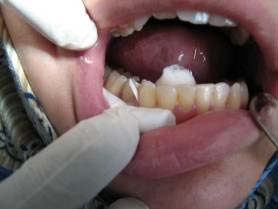 Figure 5 : EGF concentrations in individual bleeding for probing values.