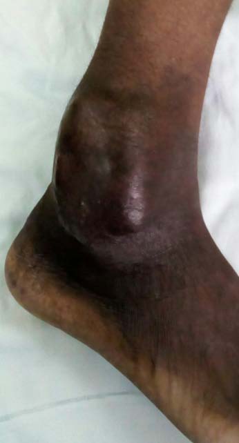 Figure 1: Showing mass and hyperpigmented skin