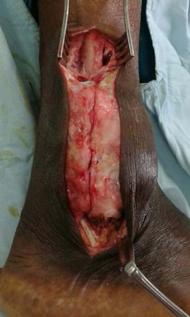 Figure 2: Radiograph (AP ankle) demonstrating tumour with lateral cortical breach