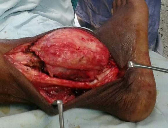 Figure 3: Showing lateral approach to the mass