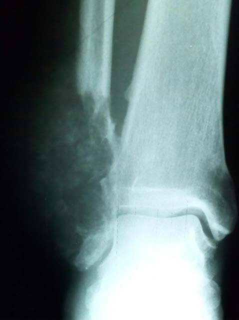 Figure 4: Showing proximal resection margin