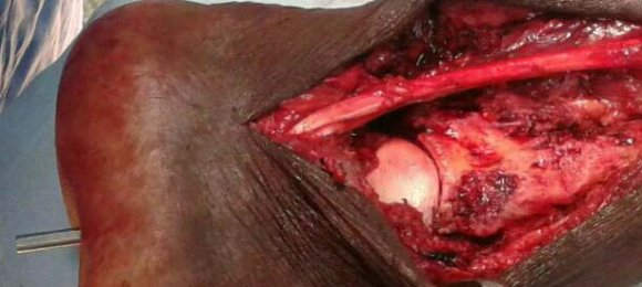 Figure 5: Showing cortical irregularity of tibia, and Steinmann pin in situ